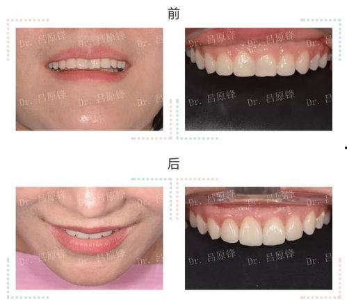 微创贴面的明星,微创贴面技术引领美容新潮流